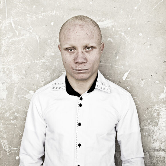 Aliou, Ivoirrien, Albinos / © Loreleï Buser Suero